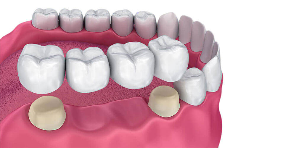 Dental Bridges Sudbury