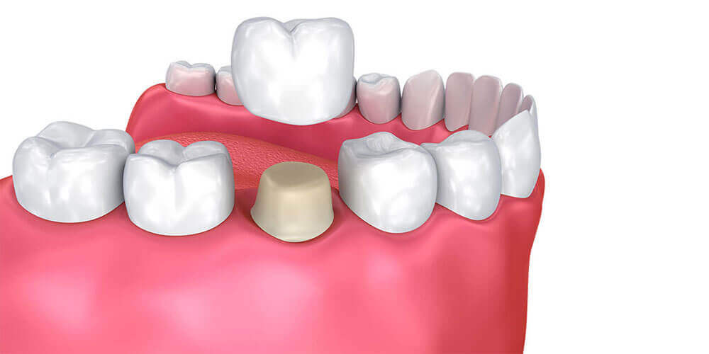 Dental Crowns Sudbury