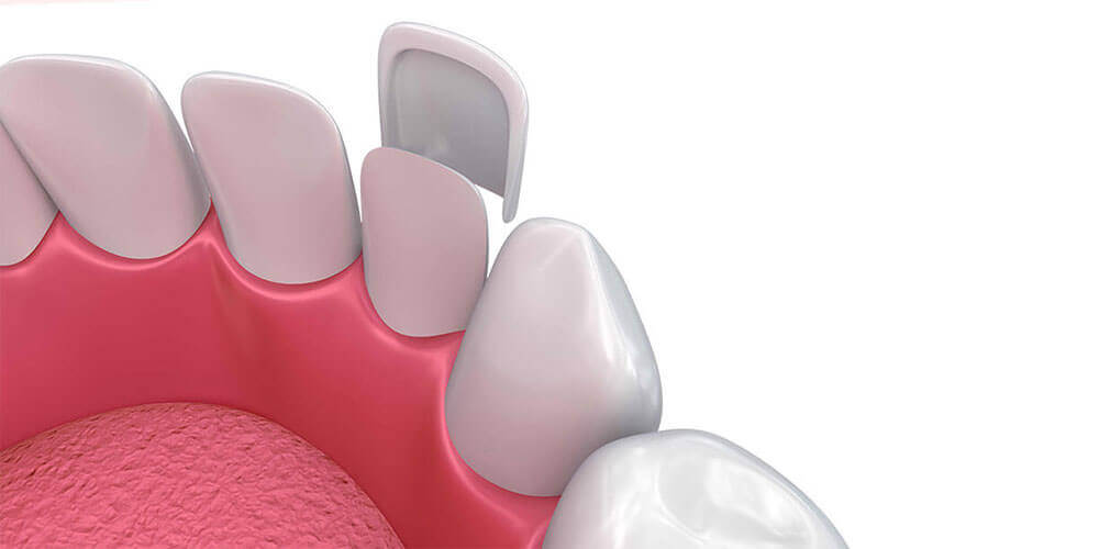 Dental Veneers Sudbury