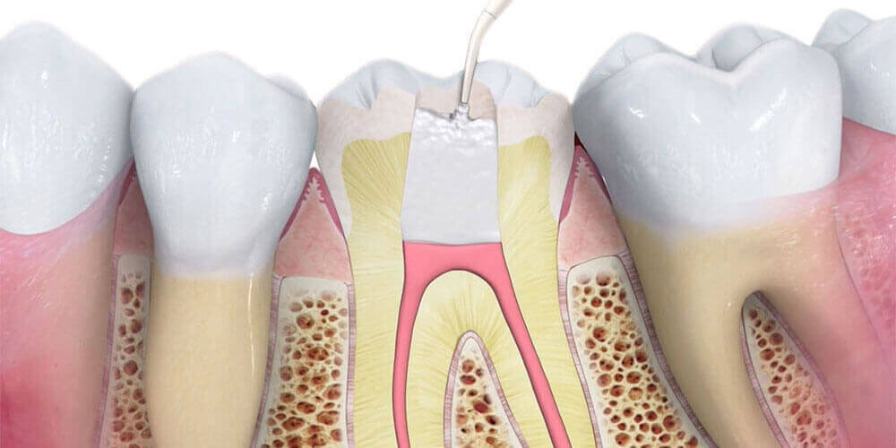 Root Canal Treatment Sudbury