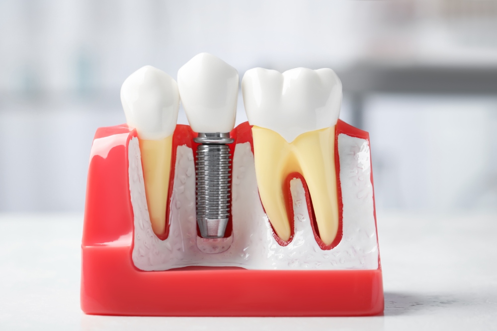 A Complete Guide to Replacing Missing Teeth